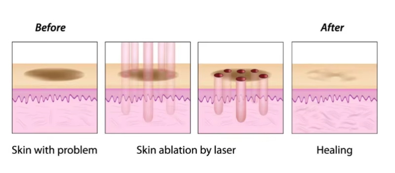 Machine indolore d'élimination des cicatrices au laser fractionné CO2